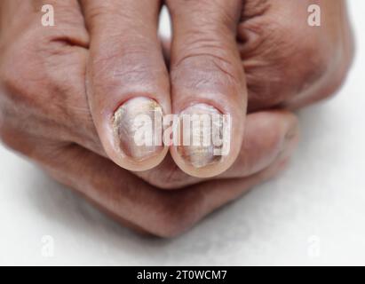 Vista ravvicinata delle unghie viziate delle mani di una paziente diabetica asiatica anziana Foto Stock