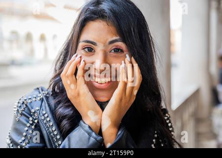 Ritratto di un'adolescente sorridente con vitiligine che tocca il viso con le mani Foto Stock