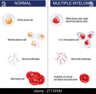 Mieloma multiplo. Differenza tra neoplasia maligna normale ed ematologica. i leucociti mutano e producono plasmacellule anomale. Il mieloma sopprime il ringhimento Illustrazione Vettoriale