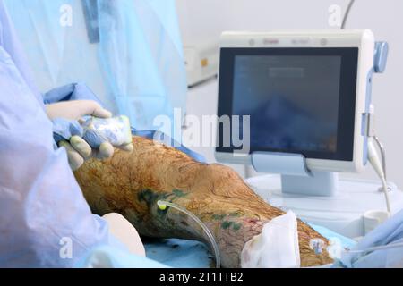 Chirurgia medica per fotocoagulazione laser endovenosa della grande vena safena. Miniphlegectomy. Vena della coagulazione laser endovenosa. Foto Stock