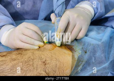 Chirurgia medica per fotocoagulazione laser endovenosa della grande vena safena. Miniphlegectomy. Vena della coagulazione laser endovenosa. Foto Stock