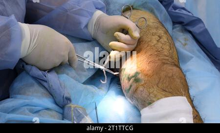 Chirurgia medica per fotocoagulazione laser endovenosa della grande vena safena. Miniphlegectomy. Vena della coagulazione laser endovenosa. Foto Stock