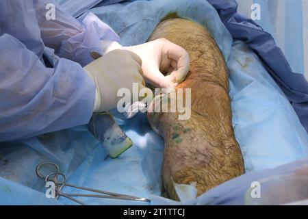 Chirurgia medica per fotocoagulazione laser endovenosa della grande vena safena. Miniphlegectomy. Vena della coagulazione laser endovenosa. Foto Stock