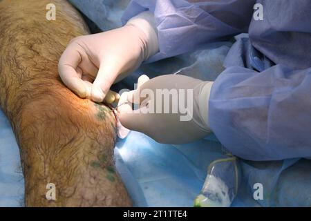 Chirurgia medica per fotocoagulazione laser endovenosa della grande vena safena. Miniphlegectomy. Vena della coagulazione laser endovenosa. Foto Stock