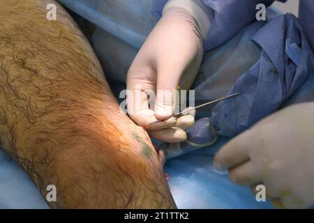 Chirurgia medica per fotocoagulazione laser endovenosa della grande vena safena. Miniphlegectomy. Vena della coagulazione laser endovenosa. Foto Stock