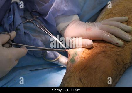 Chirurgia medica per fotocoagulazione laser endovenosa della grande vena safena. Miniphlegectomy. Vena della coagulazione laser endovenosa. Foto Stock