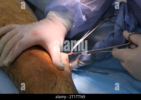 Chirurgia medica per fotocoagulazione laser endovenosa della grande vena safena. Miniphlegectomy. Vena della coagulazione laser endovenosa. Foto Stock