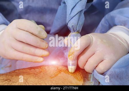 Chirurgia medica per fotocoagulazione laser endovenosa della grande vena safena. Miniphlegectomy. Vena della coagulazione laser endovenosa. Foto Stock