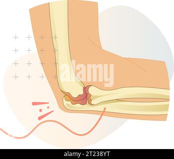 Epicondilite laterale conosciuta come gomito da tennis - Stock Illustration as EPS 10 file Illustrazione Vettoriale