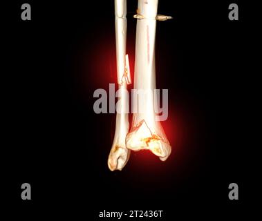 TC scansione dell'articolazione della caviglia immagine di rendering 3D che mostra frattura tibia e osso del perone. Foto Stock