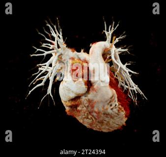 CTA torace o CTPA con mezzo di contrasto rendering 3D per embolia polmonare diagnostica (PE) . Foto Stock