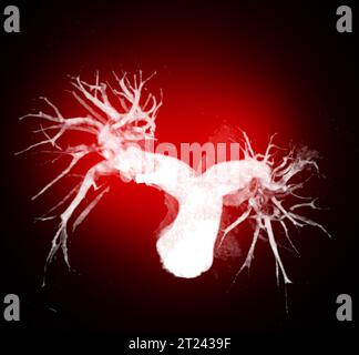 CTA torace o CTPA con mezzo di contrasto rendering 3D per embolia polmonare diagnostica (PE) . Foto Stock