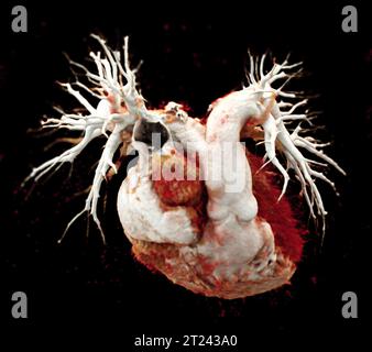 CTA torace o CTPA con mezzo di contrasto rendering 3D per embolia polmonare diagnostica (PE) . Foto Stock