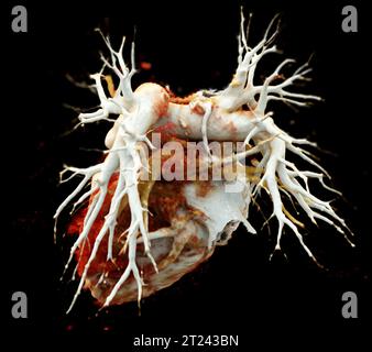 CTA torace o CTPA con mezzo di contrasto rendering 3D per embolia polmonare diagnostica (PE) . Foto Stock