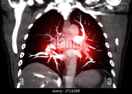CTA torace o CTPA con mezzo di contrasto vista coronale che mostra embolia polmonare (PE) . Foto Stock
