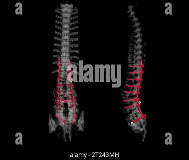 Scansione TC del rendering 3d della colonna toracica e lombare che mostra l'impianto a vite pedicle dopo decompressione chirurgica e fusione spinale. Foto Stock