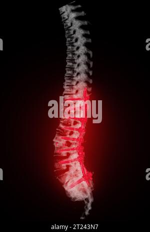 Scansione TC del rendering 3d della colonna toracica e lombare che mostra l'impianto a vite pedicle dopo decompressione chirurgica e fusione spinale. Foto Stock