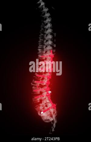 Scansione TC del rendering 3d della colonna toracica e lombare che mostra l'impianto a vite pedicle dopo decompressione chirurgica e fusione spinale. Foto Stock