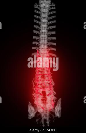 Scansione TC del rendering 3d della colonna toracica e lombare che mostra l'impianto a vite pedicle dopo decompressione chirurgica e fusione spinale. Foto Stock