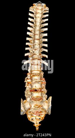 Scansione TC del rendering 3d della colonna toracica e lombare che mostra l'impianto a vite pedicle dopo decompressione chirurgica e fusione spinale. Foto Stock