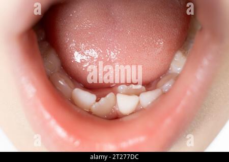 Denti in crescita acuta per sostituire i denti del latte in un bambino. Nella seconda fila di denti, il dente cresce mentre l'incisivo non è ancora caduto. Foto Stock