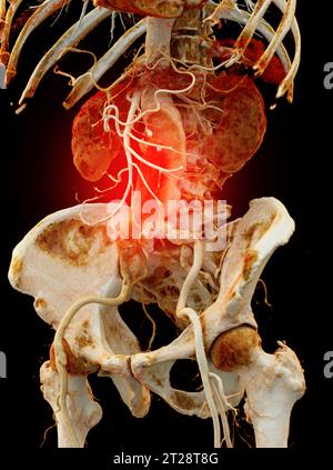 CTA aorta addominale che mostra il rendering 3D della dissezione aortica addominale. Foto Stock