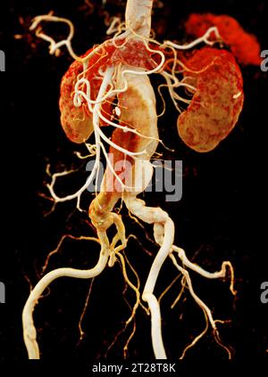 CTA aorta addominale che mostra il rendering 3D della dissezione aortica addominale. Foto Stock