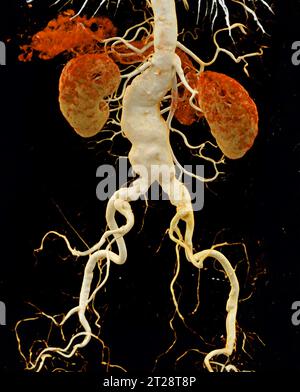 CTA aorta addominale che mostra il rendering 3D della dissezione aortica addominale. Foto Stock