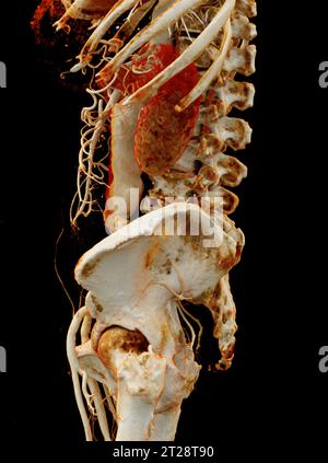 CTA aorta addominale che mostra il rendering 3D della dissezione aortica addominale. Foto Stock