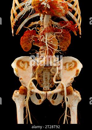 CTA aorta addominale che mostra il rendering 3D della dissezione aortica addominale. Foto Stock