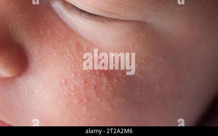 Brufoli allergici in un neonato sul viso. Patogenesi, acne dei neonati, primo piano Foto Stock