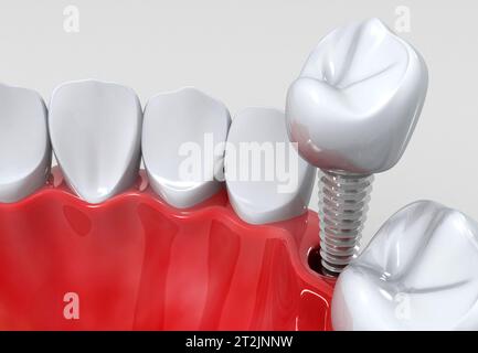 Impianti dentali invece di denti danneggiati. rendering 3d. Foto Stock