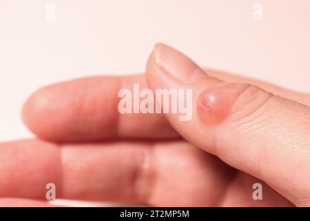 Mano femminile con igroma del pollice. Messa a fuoco selettiva. Foto Stock