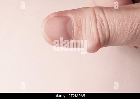 Cisti del ganglio (malattia della cisti sinoviale) sul pollice della mano di una donna. Messa a fuoco selettiva. Foto Stock