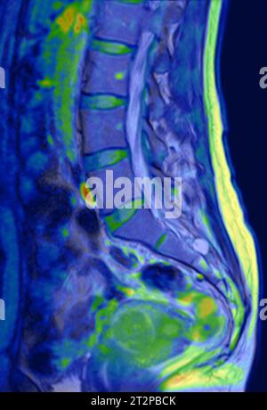 Risonanza magnetica colorata (MRI) scansione di una colonna lombare sana (inferiore). Foto Stock