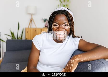 Ritratto di una giovane donna africana sorridente con vitiligo seduto sul divano a casa Foto Stock