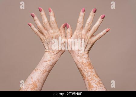 Donna che mostra le mani con vitiligine su sfondo rosa Foto Stock