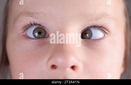 Viso del bambino con squarci e branelle sul naso. Foto Stock