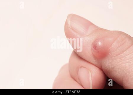 Cisti del ganglio (malattia della cisti sinoviale) sul pollice della mano di una donna. Messa a fuoco selettiva. Foto Stock