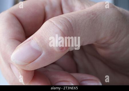 Mano femminile con igroma del pollice. Messa a fuoco selettiva. Foto Stock
