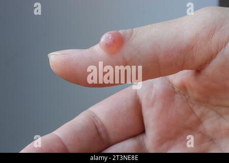 Mano femminile con igroma del pollice. Messa a fuoco selettiva. Foto Stock
