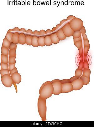 Sindrome dell'intestino irritabile. Sintomi IBS. Disturbi gastrointestinali. Colon spastico. Illustrazione vettoriale Illustrazione Vettoriale