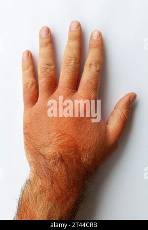 La mano di un uomo bruciata con acqua bollente. Su di esso ci sono arrossamento e vesciche. Foto Stock