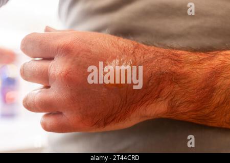 La mano di un uomo bruciata con acqua bollente. Su di esso ci sono arrossamento e vesciche. Foto Stock