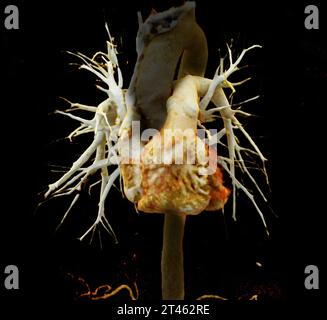 Arteria polmonare CTA o CTPA con mezzo di contrasto rendering 3D dell'arteria polmonare normale. Foto Stock