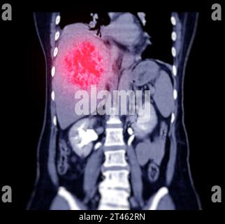 CT vista coronale dell'addome superiore che mostra DDX è HCC atipico o carcinoma epatocellulare. Foto Stock