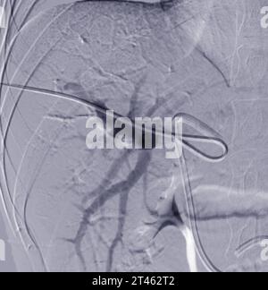 L'embolizzazione della vena portale (PVE) è una procedura medica utilizzata per mantenere la porzione del fegato crescere e diventare più sani prima dell'intervento chirurgico. Foto Stock