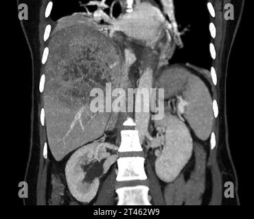 CT vista coronale dell'addome superiore che mostra DDX è HCC atipico o carcinoma epatocellulare. Foto Stock