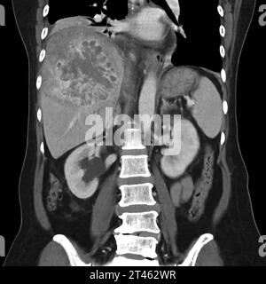 CT vista coronale dell'addome superiore che mostra DDX è HCC atipico o carcinoma epatocellulare. Foto Stock