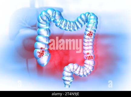 Concetto di cancro del colon su sfondo medico. illustrazione 3d. Foto Stock